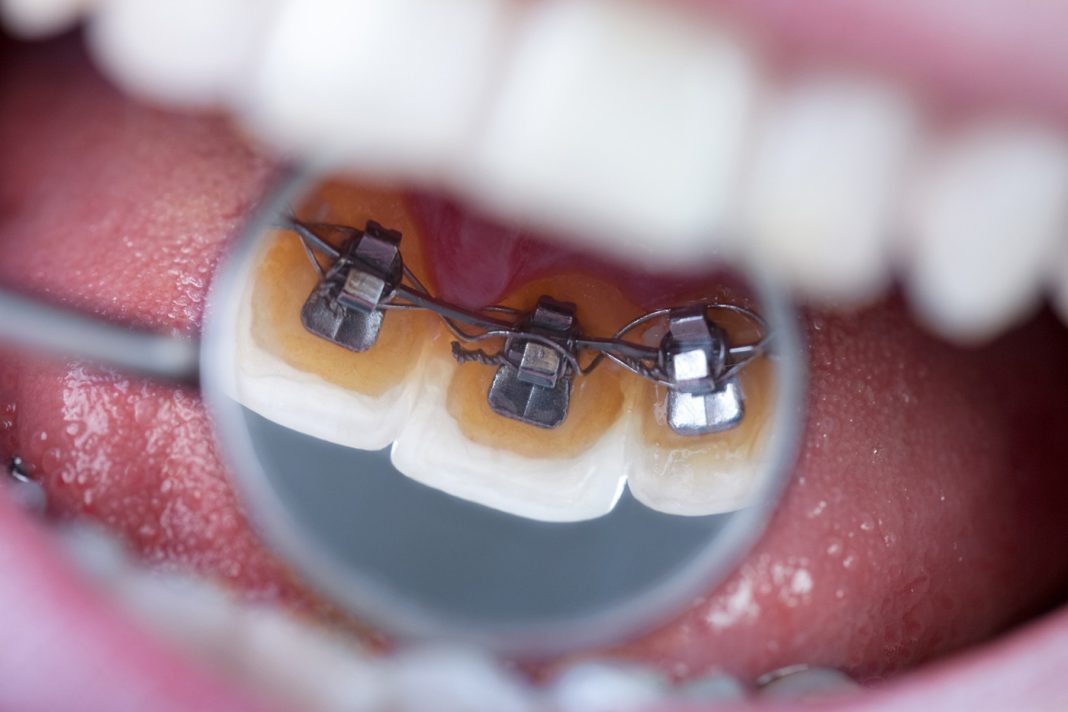 Lingual görünmez diş teli tedavi hakkında bilinmesi gerekenler