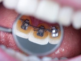 Lingual görünmez diş teli tedavi hakkında bilinmesi gerekenler