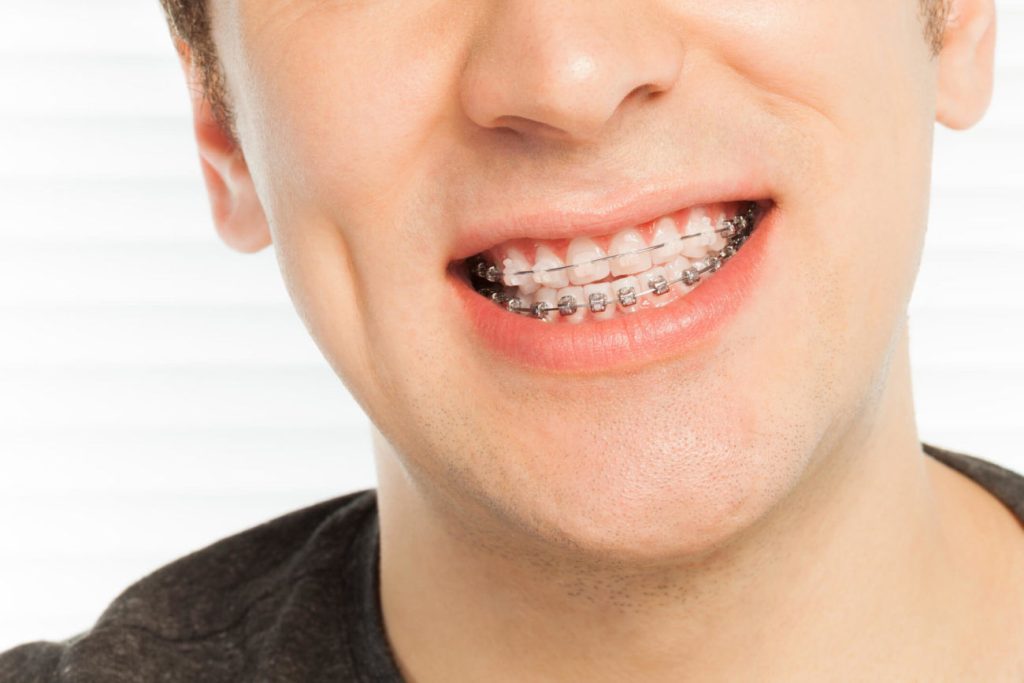 Porselen şeffaf diş teli tedavisi hakkında bilinmesi gerekenler