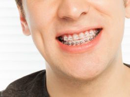Porselen şeffaf diş teli tedavisi hakkında bilinmesi gerekenler