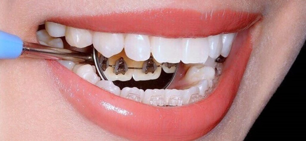 Lingual diş telinin diğer diş tellerinden farkı nedir?