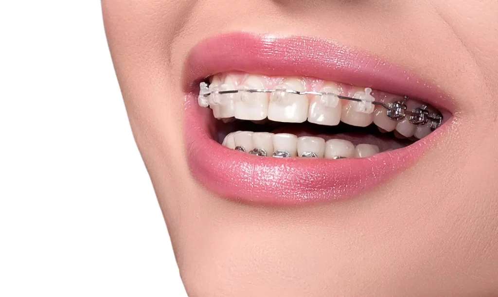 Metal diş teli tedavisi kimlere uygulanır?