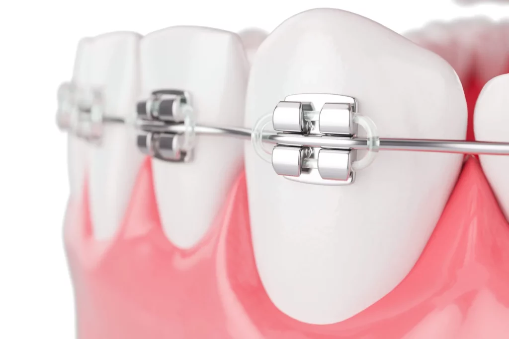 Diş teli tedavisi ne zaman yapılır? 